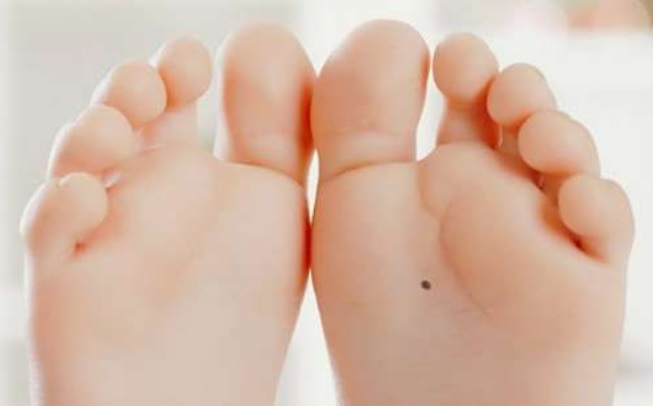 nốt ruồi ở lòng bàn chân nói lên điều gì