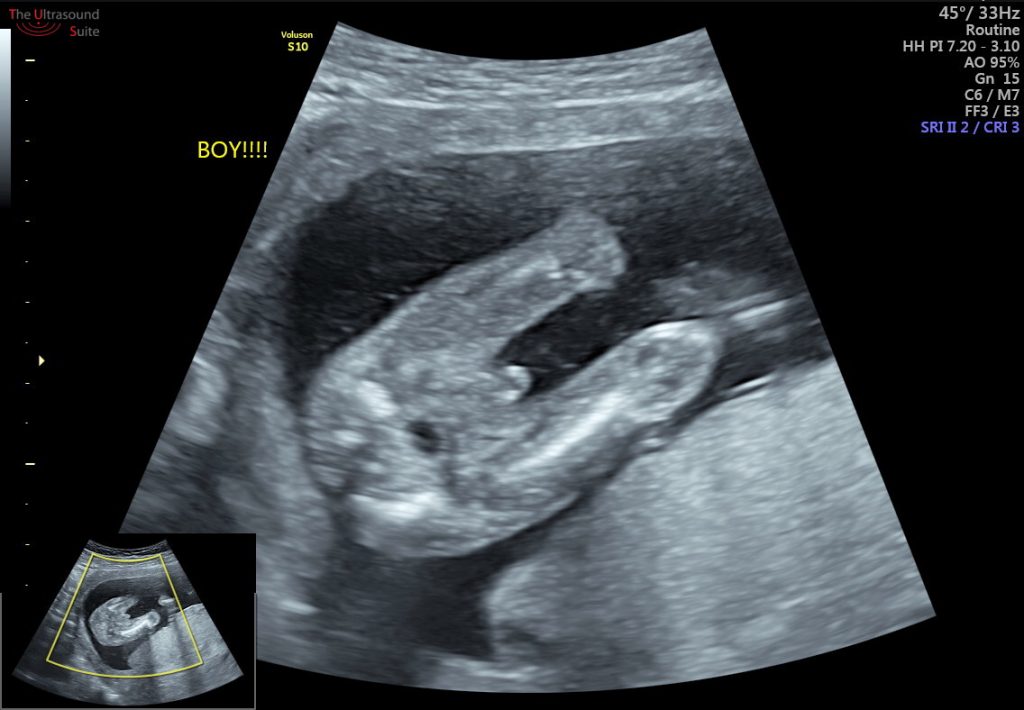 hình ảnh siêu âm bộ phận sinh dục bé trai