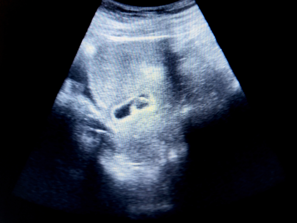 Hình ảnh siêu âm thai 5 tuần
