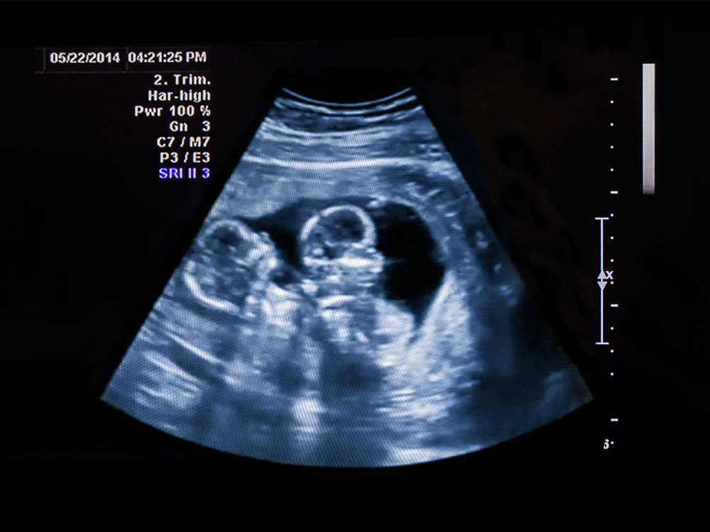Sự phát triển của thai đôi tuần 18-22