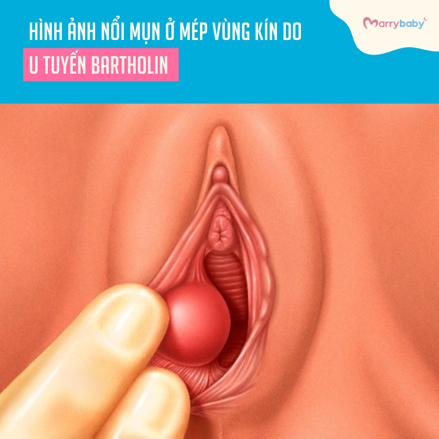 Hình ảnh nổi mụn ở mép vùng kín do u tuyến Bartholin