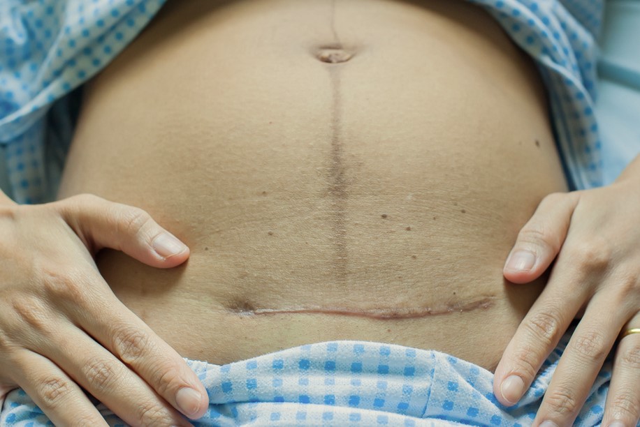 Chăm sóc bụng sau khi sinh mổ giúp mẹ nhanh chóng phục hồi