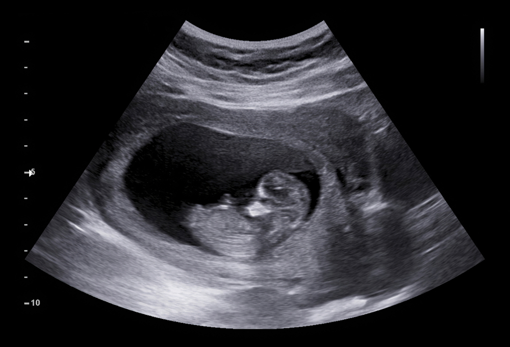 siêu âm thai 3 tháng đầu