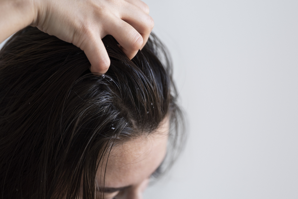 7 cách trị gàu bằng muối đơn giản mà hiệu quả cho tóc khỏe từ gốc