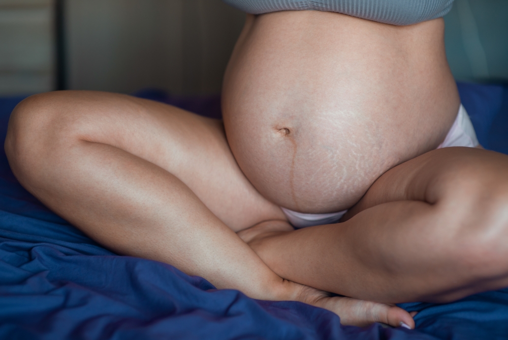 3 dấu hiệu bị rạn da khi mang thai mẹ bầu cần lưu ý