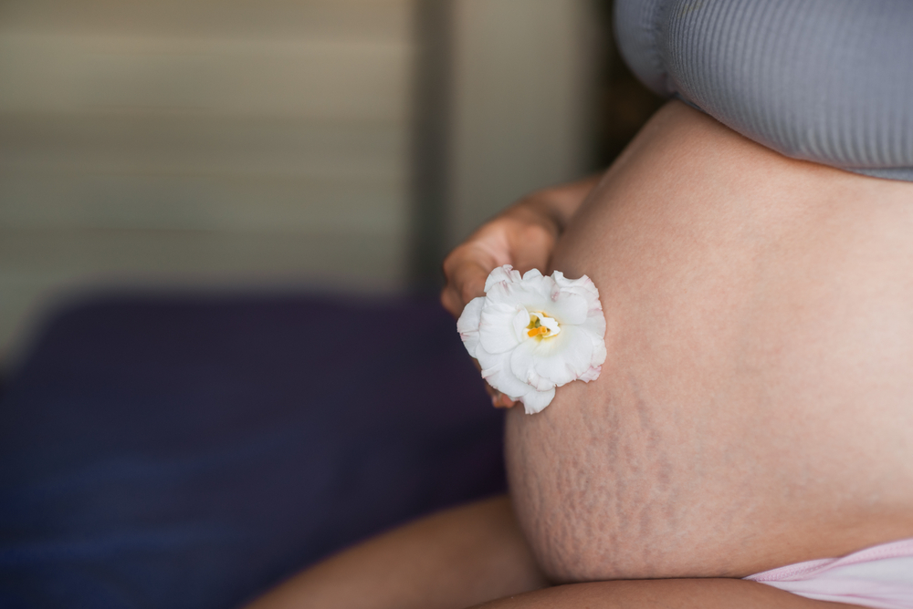 Vết rạn da khi mang thai, nỗi lo của không ít mẹ bầu