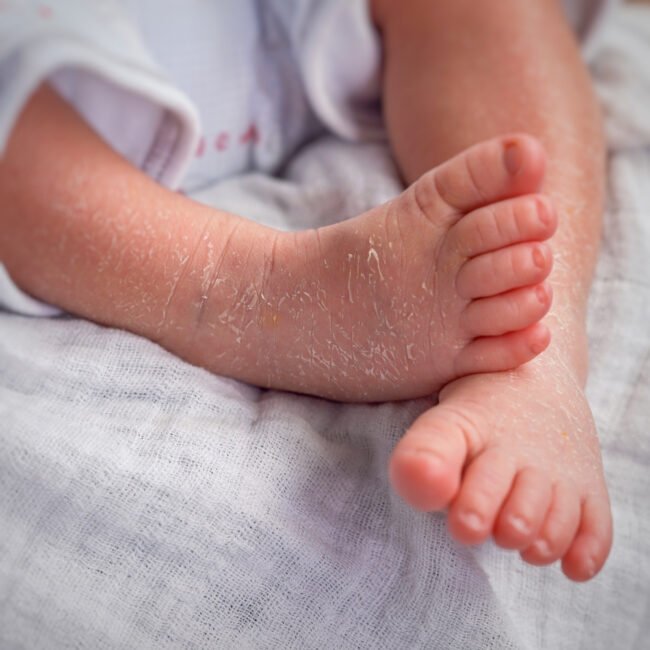 Nguyên nhân trẻ sơ sinh bị khô da bong tróc và cách chăm sóc da cho con tại nhà