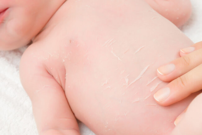 Trẻ sơ sinh bị bong tróc da là do đâu? Cách khắc phục là gì?