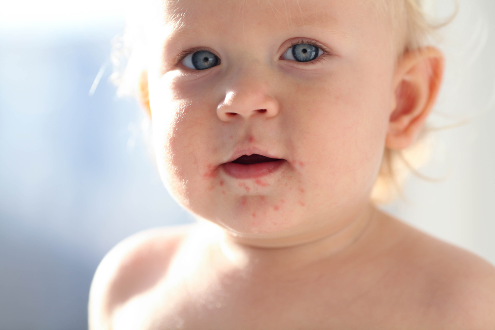 Trẻ bị nổi mẩn đỏ xung quanh miệng là bệnh gì? Cách xử lý