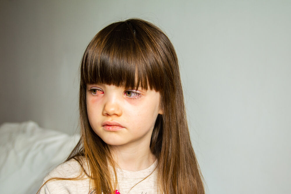 bệnh viêm kết mạc ở trẻ em