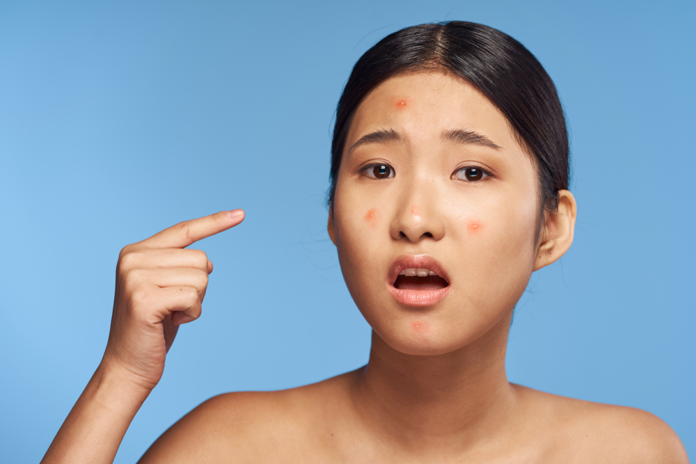 Nên làm gì sau khi nặn mụn: 6 bí quyết cần ghi nhớ để có làn da khỏe đẹp