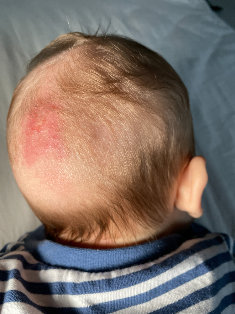 Nấm da đầu ở trẻ em: Hình ảnh, triệu chứng, nguyên nhân và cách điều trị