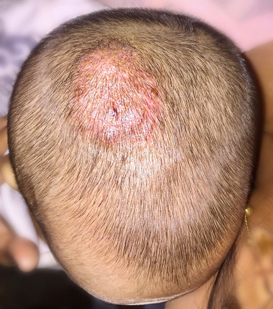 triệu chứng nấm da đầu