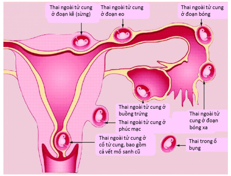 chẩn đoán thai ngoài tử cung