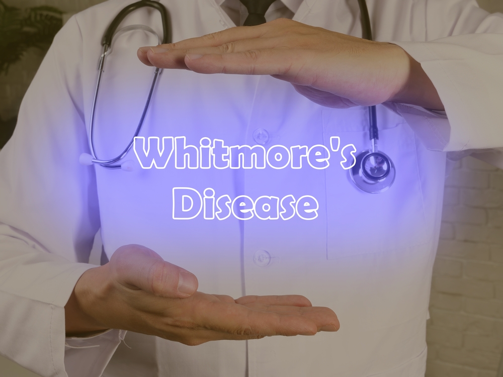 Whitmore là bệnh gì? Biểu hiện, nguyên nhân và cách điều trị