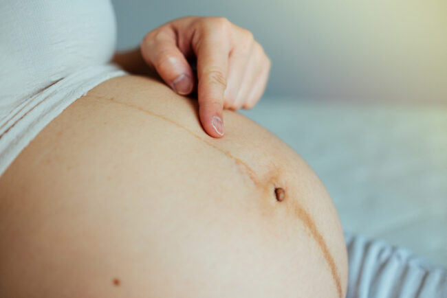 Vạch nâu ở bụng có phải có thai? Dấu hiệu mang thai dễ nhận biết!