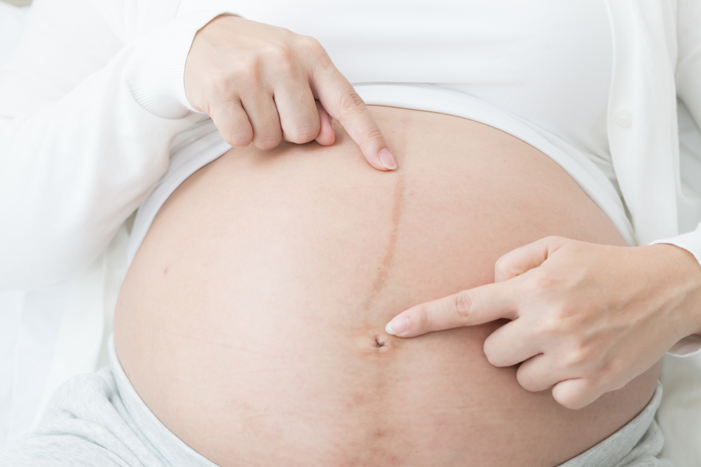 vạch nâu ở bụng có phải có thai