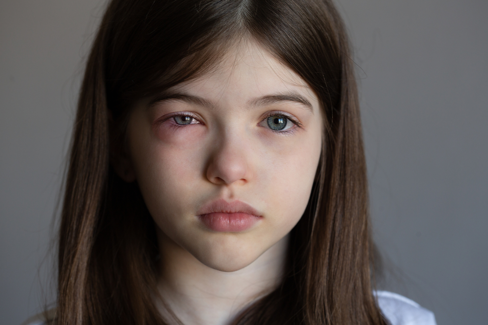Trẻ bị đau mắt đỏ bao lâu thì hết?