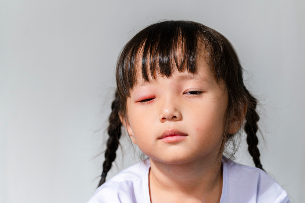 Trẻ bị đau mắt đỏ: Nguyên nhân, dấu hiệu và cách xử lý