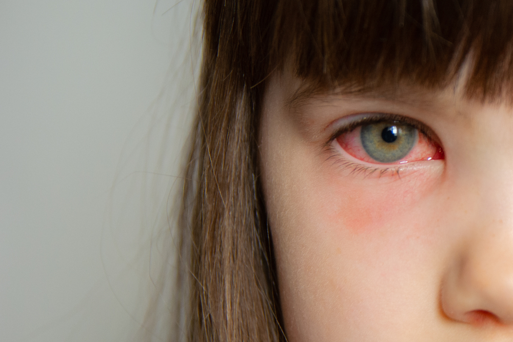 đau mắt đỏ là gì?