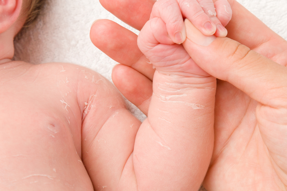 Da trẻ sơ sinh và trẻ nhỏ bị khô, bong tróc là thiếu chất gì?