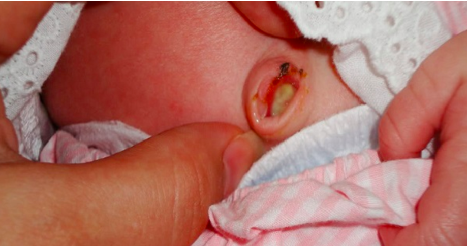 Dấu hiệu bé sắp rụng rốn nghiêm trọng có biểu hiện nhiễm trùng