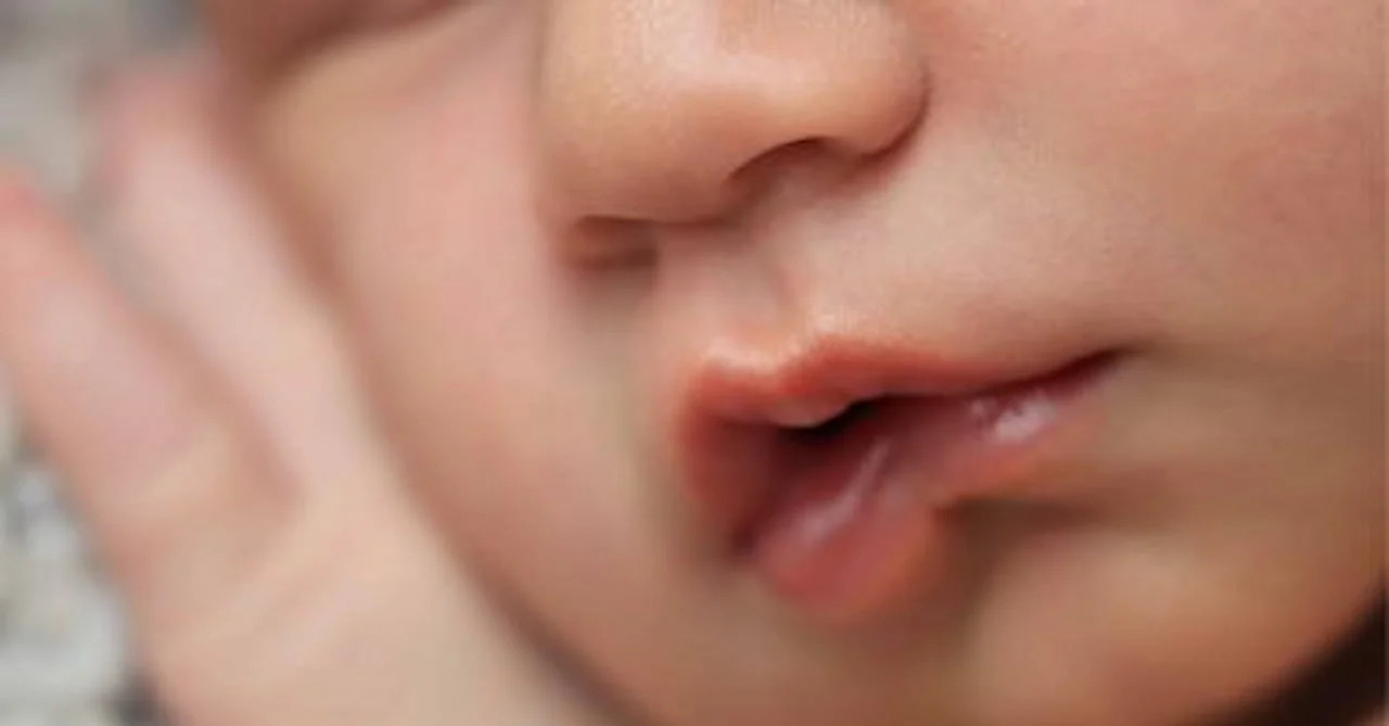 Dính thắng môi trên ở trẻ sơ sinh thường được điều trị bằng cách cắt bỏ (tiểu phẫu)