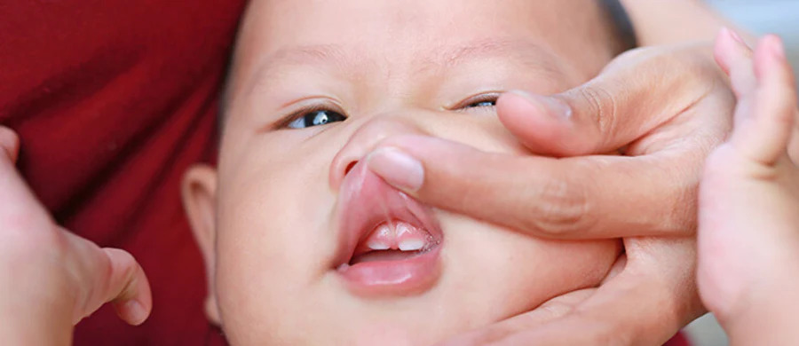 Dính thắng môi ở trẻ sơ sinh là gì? Làm sao để nhận biết và điều trị?