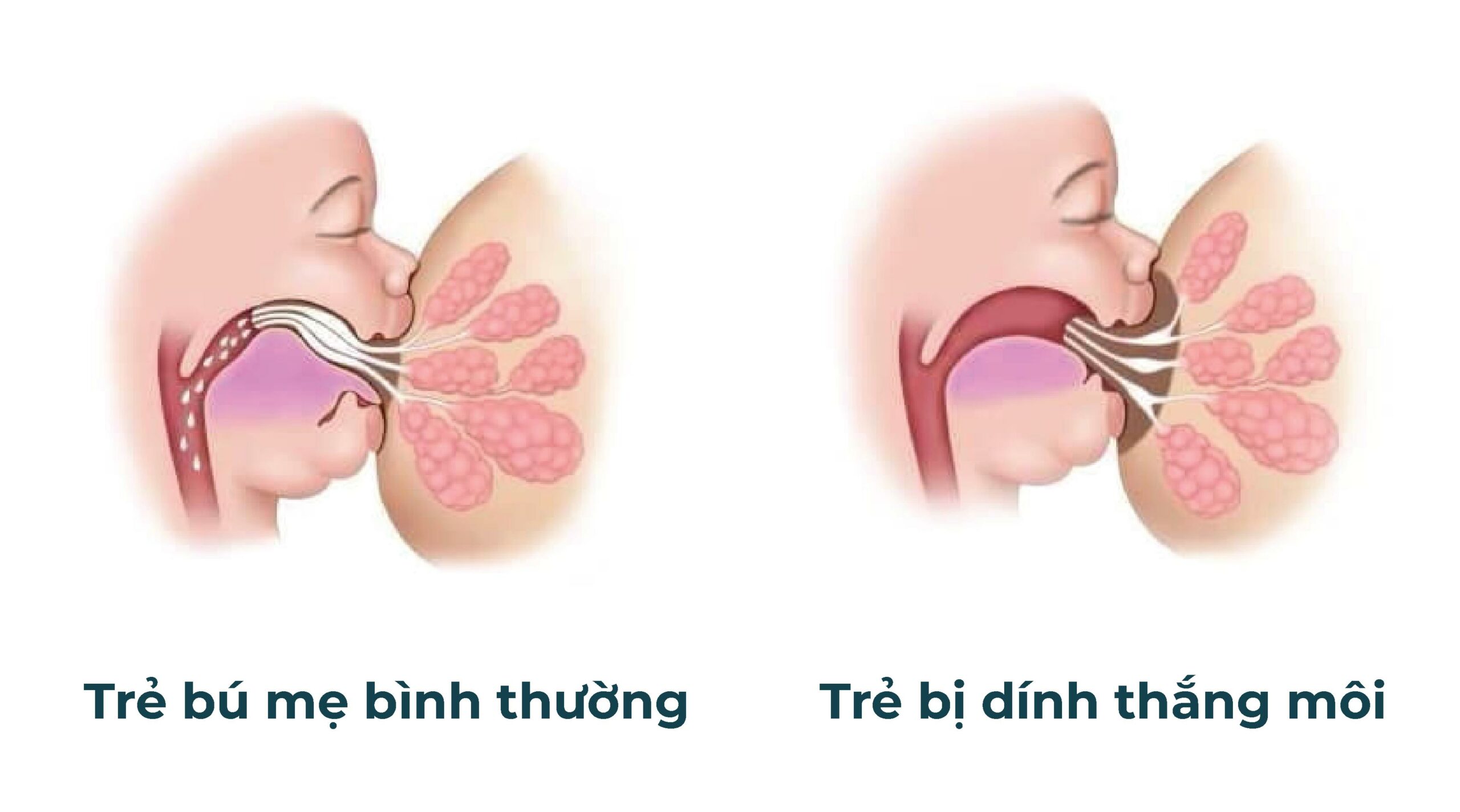 Hình ảnh minh họa tình trạng dính thắng môi trên ở trẻ sơ sinh (hình bên phải)