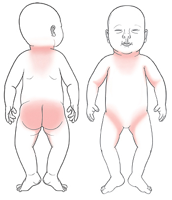 Hình ảnh minh họa những vùng da trẻ sơ sinh thường bị nổi rôm sảy