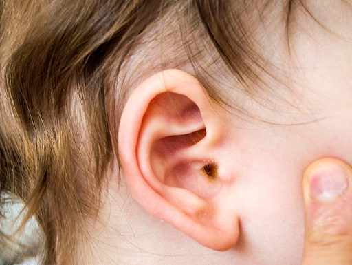 Viêm tai giữa là tình trạng nhiễm trùng tai giữa thường gặp ở trẻ nhỏ.