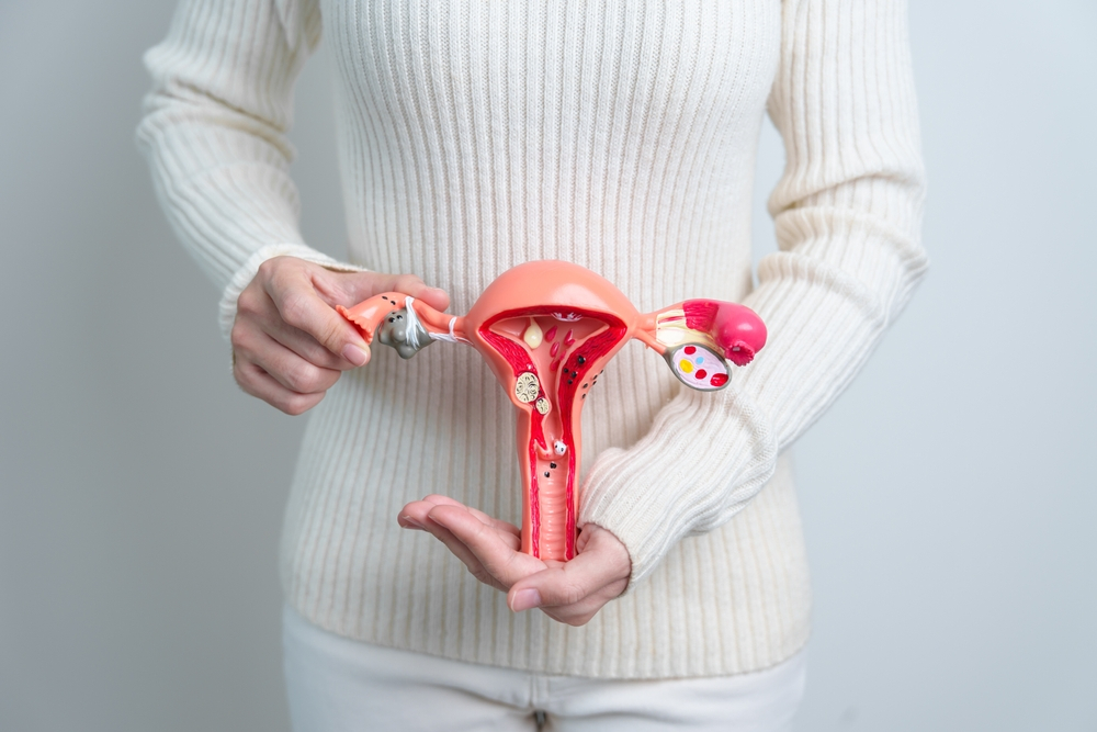 Lạc nội mạc tử cung có thể là nguyên nhân dẫn đến vô sinh
