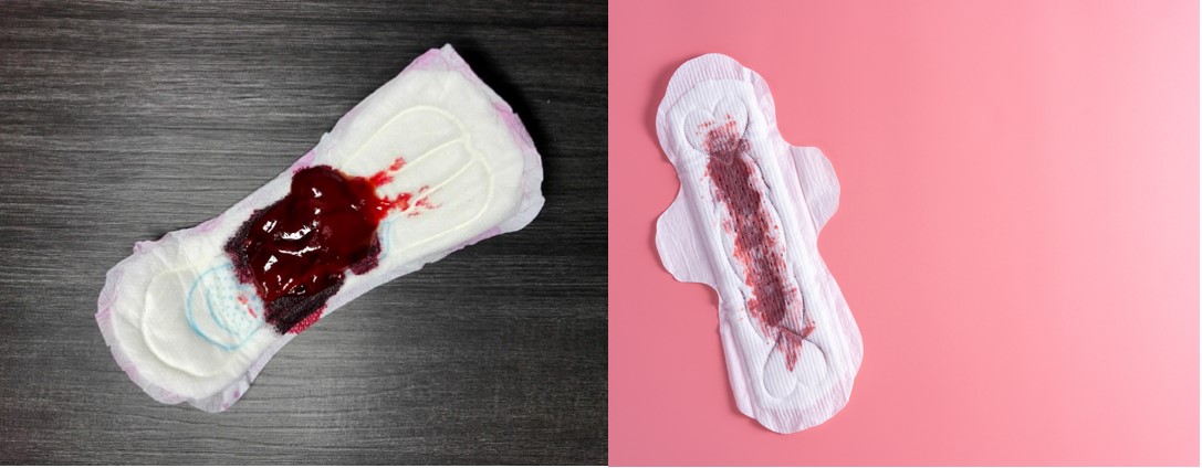 Cách phân biệt máu kinh và máu sảy thai: Hình ảnh máu sảy thai (bên trái) và máu kinh (bên phải)