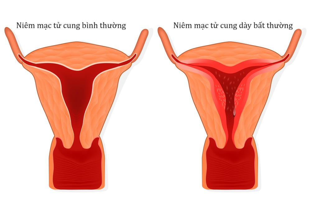 Niêm mạc tử cung bao nhiêu là bình thường và bao nhiêu là bất thường?
