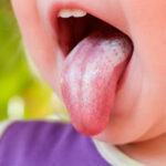Nấm lưỡi ở trẻ sơ sinh: Nguyên nhân và cách điều trị đúng cách