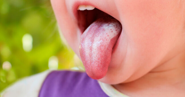 Nấm lưỡi ở trẻ sơ sinh: Nguyên nhân và cách điều trị đúng cách