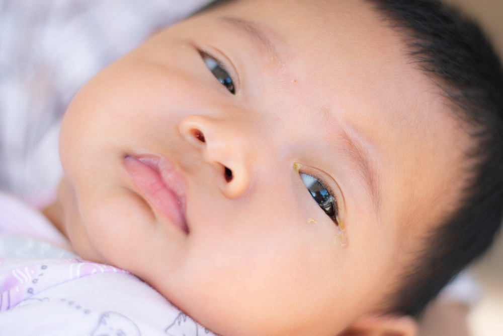 Tắc tuyến lệ ở trẻ sơ sinh: Nguyên nhân, dấu hiệu và cách điều trị